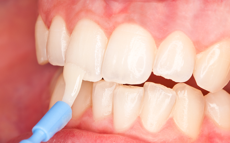 تاثیر فلوراید بر سلامت دندان ها