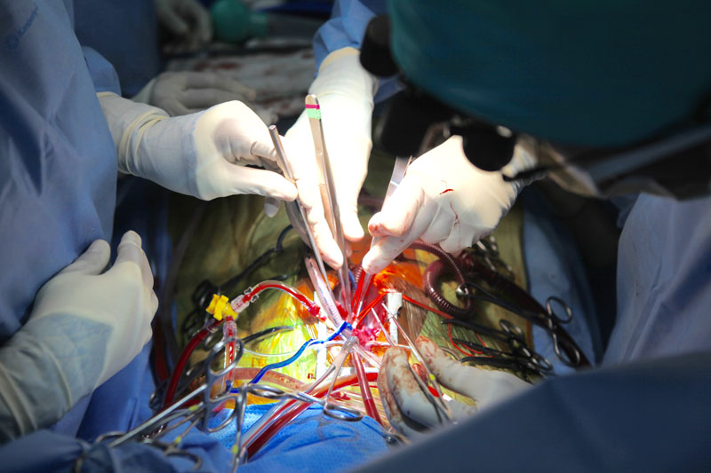 جراحی قلب / عمل قلب باز
